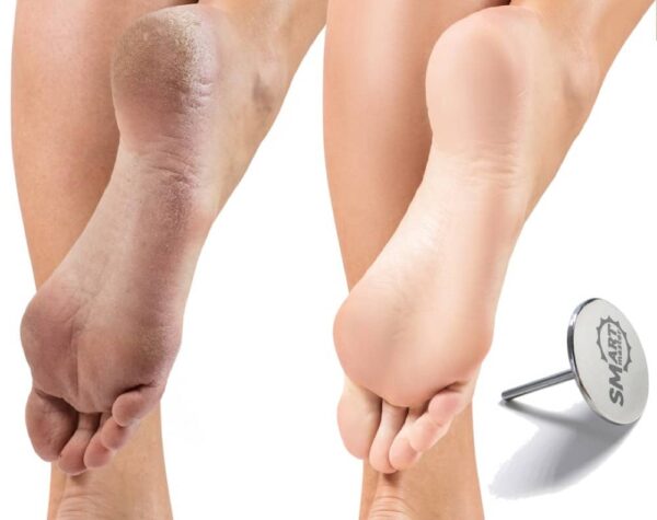 smart_pedicure_charm ALUS SMART DISK BABY